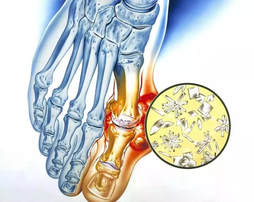 【细胞新闻】干细胞疗法:拯救痛风患者,不止只有药